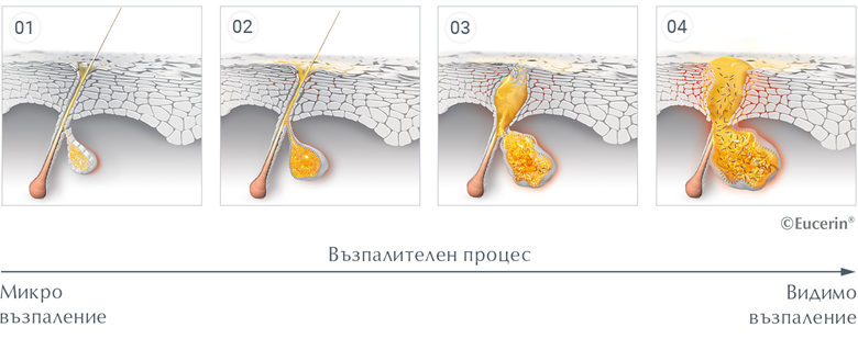 Възпалението причинява акне