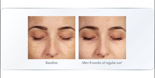 Best serum for hyperpigmentation