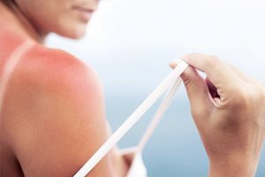 Изгаряне на кожата: слънчево изгаряне на гърба