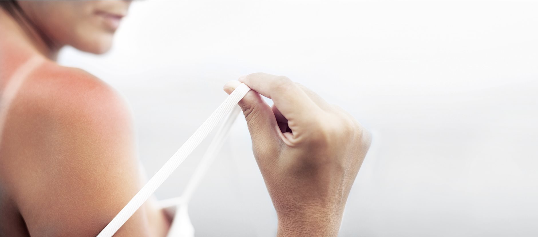 Грижа за кожата при леки изгаряния